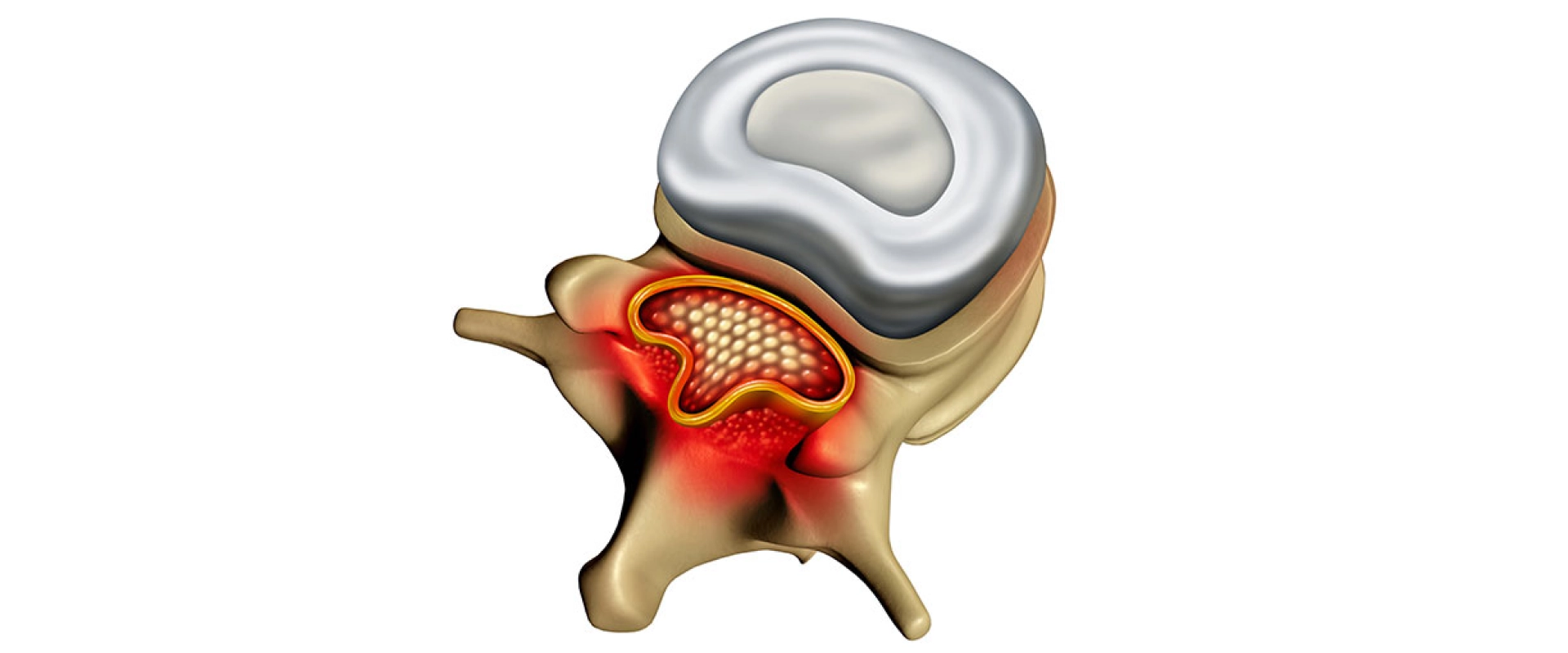 Estenose Vertebral