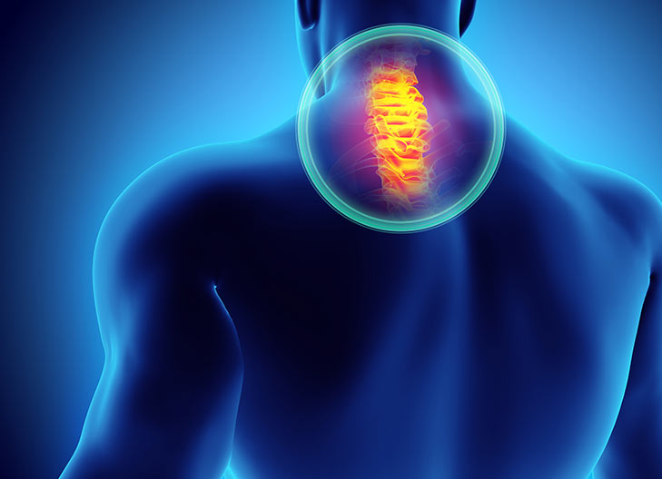 Foraminotomia Cervical Posterior